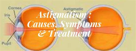 Astigmatism : Causes, Symptoms & Treatment | Eyemantra