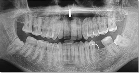 FULL TEXT - Management of an impacted inverted mesiodens associated with a large circumferential ...