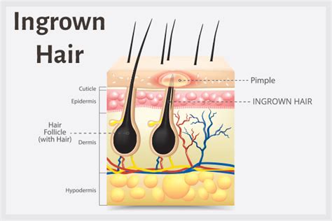 Ingrown Hair: Causes, Symptoms, & Treatment - eMediHealth