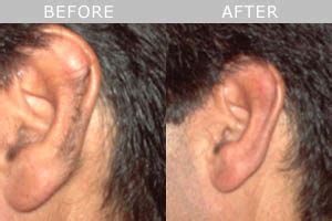 Laser Hair Removal | Medical Laser Solutions