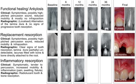 Survival and complication analyses of avulsed and replanted permanent ...