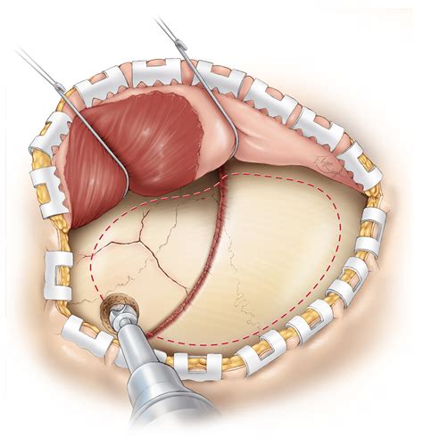 Epidural Hematoma | The Neurosurgical Atlas