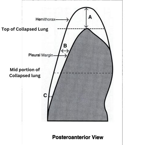 Pneumothorax Percentage Calculator - RadioGyan