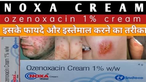 Noxa cream uses does and side effects full review - YouTube