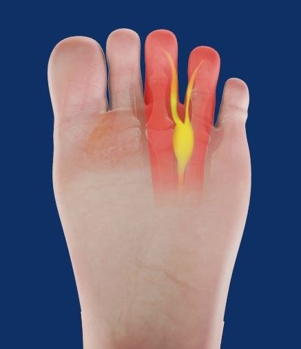 Morton's Neuroma Glendale | Foot Pain Treatment Los Angeles | Pasadena