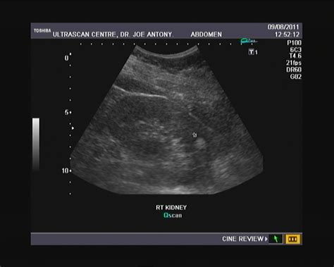 Ultrasound imaging: Sonography of angiomyolipoma: