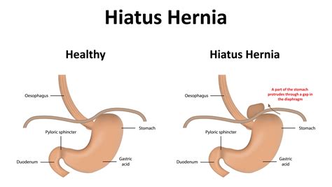 Sign in | Hernia repair, Hiatus hernia, Bariatric surgeon