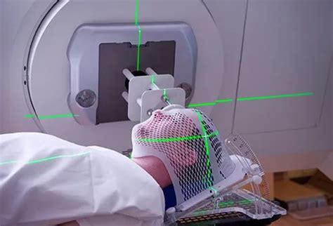 What Are the Side Effects of Stereotactic Radiosurgery?