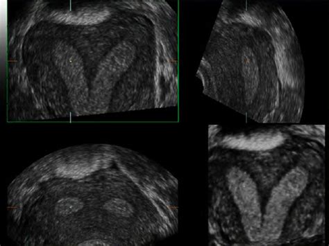 How to diagnose the uterine septum in a noninvasive way?