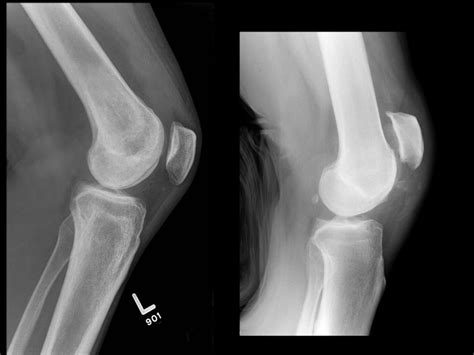 What is a Quadriceps Tendon Rupture?