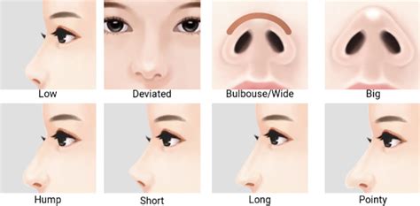 Rhinoplasty for Dummies - What you must know before a nose job!