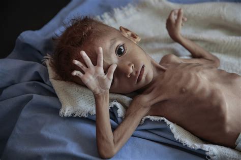 Aid group: 85,000 children may have died of hunger in Yemen