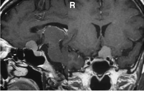 T 1 -weighted magnetic resonance images showing the homogeneous ...