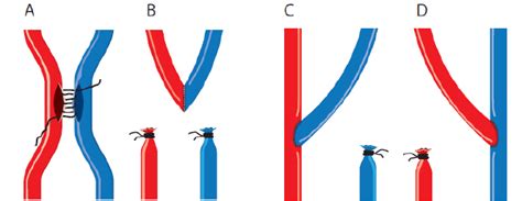 Four different types anastomotic configurations: A) Side-to-side... | Download Scientific Diagram