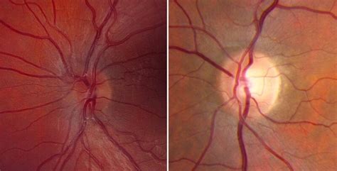 Rare eye disease gene therapy lacks efficacy in NIH-funded trial