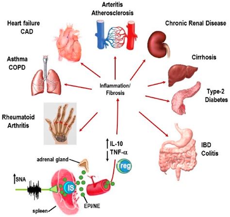 IJMS | Free Full-Text | Sympathetic Nerve Hyperactivity in the Spleen: Causal for Nonpathogenic ...