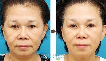 Genuine Ulthera Non-Surgical Ultherapy Skin Rejuvenation & Tightening