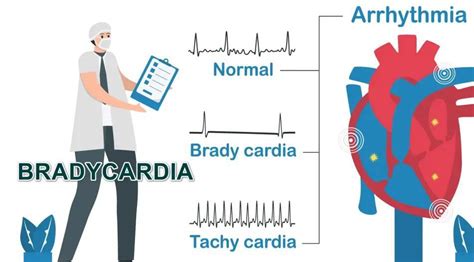 Treatment for Sinus bradycardia - MEDizzy