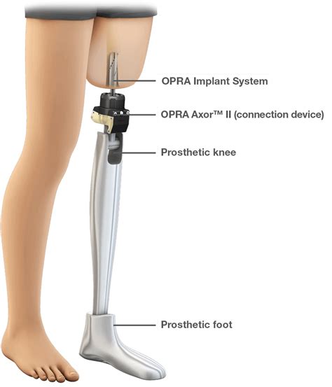 FDA authorizes use of prosthesis for rehabilitation of above-the-knee ...