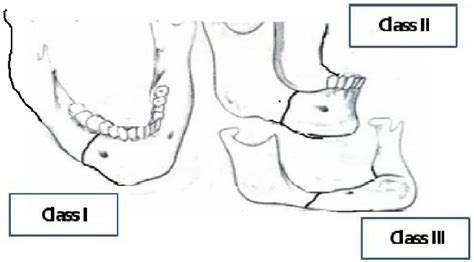 Dentition classification of mandibular fracture. • Class I: Teeth are ...