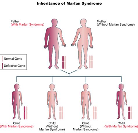 Marfan Syndrome - Causes, Symptoms, Prognosis, Diagnosis, Treatment