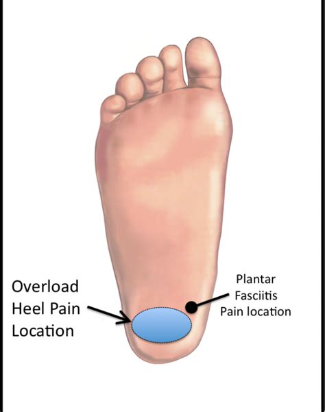 Overload Heel Pain Syndrome - FootEducation