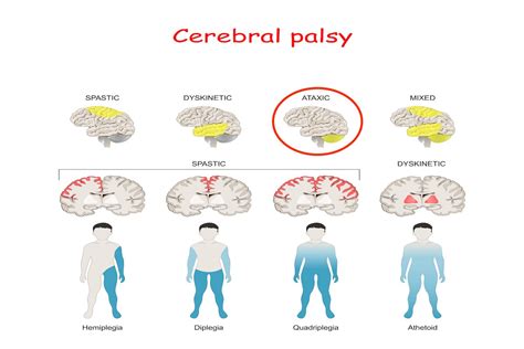 Ataxic Cerebral Palsy | LegalFinders