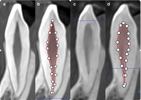 a Sagittal section of the upper left maxillary canine of 15 year old ...