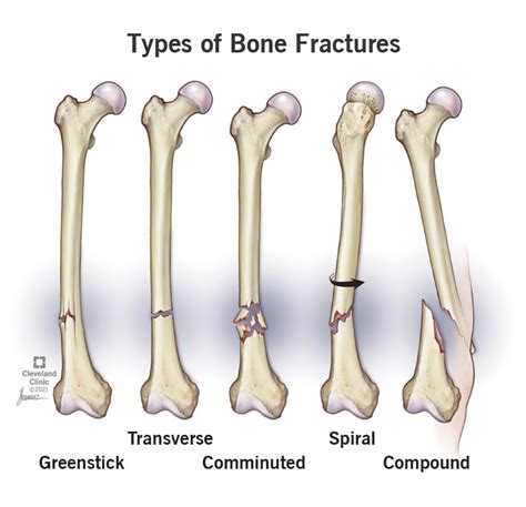 Compound Fracture