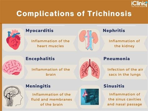 Trichinosis (Pork Parasite) Pathophysiology, Signs, 57% OFF