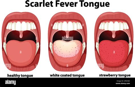 Scarlet fever tongue symptoms illustration Stock Vector Image & Art - Alamy