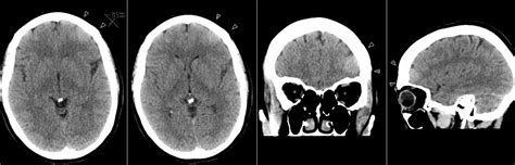 Radiology MRI: Incidental Meningioma