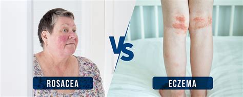 Rosacea vs Eczema: How to Tell the Difference