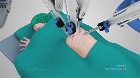 Robotic Lung Surgery