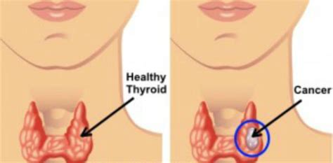 Thyroid Cancer Causes, Symptoms, Diagnosis and Treatment - Natural Health News