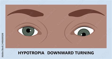 Diplopia double vision test exam brain nerve dry eye palsy gravis ...