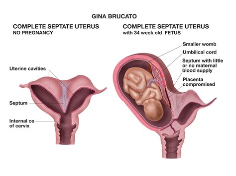 Didelphys Uterus Ultrasound