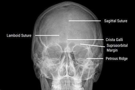 Sinus X-Ray Positioning: An X-Ray Guide - Medical Professionals