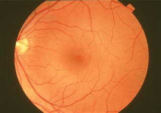 Macula Lutea - Its Role In Macular Degeneration