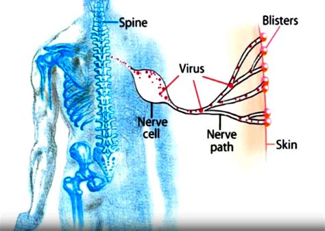 Preventing Shingles | NIH News in Health