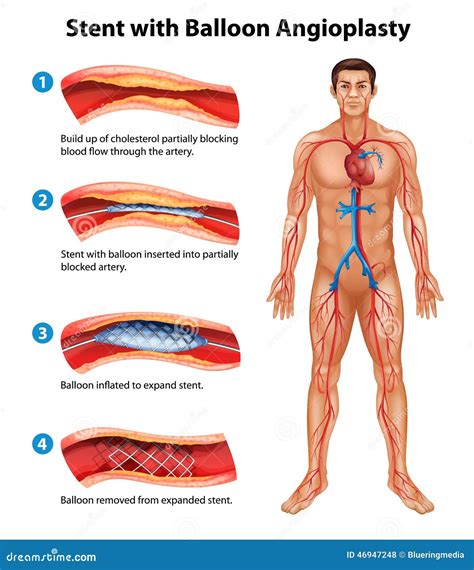 Stent Angioplasty Procedure Stock Vector - Illustration of embolism ...