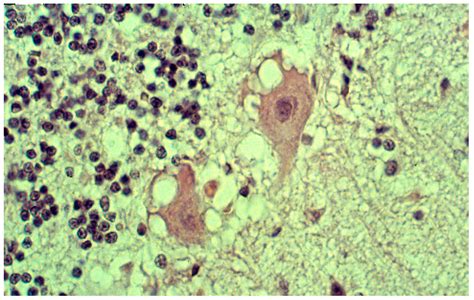 Kuru, the First Human Prion Disease