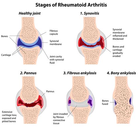 Rheumatoid Arthritis | Singapore Physiotherapists provide physiotherapy treatments for pain relief