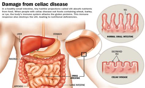 Coeliac Disease