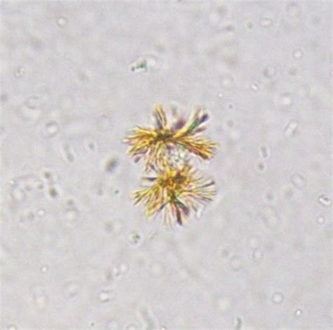 Bilirubin Crystal In Urine