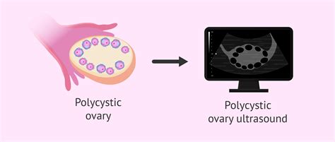 Polycystic ovary ultrasound