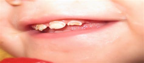 Baby bottle tooth decay treatment solutions are provided at our clinic