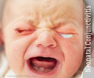 Neonatal Conjunctivitis - References