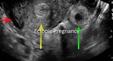 emDOCs.net – Emergency Medicine EducationemDOCs Podcast – Episode 30: Ectopic Pregnancy - emDOCs ...