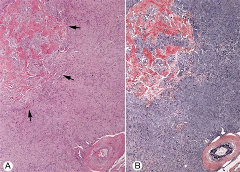 Hilar Cell Tumor. A, This area of tumor included a zone of stromal ...